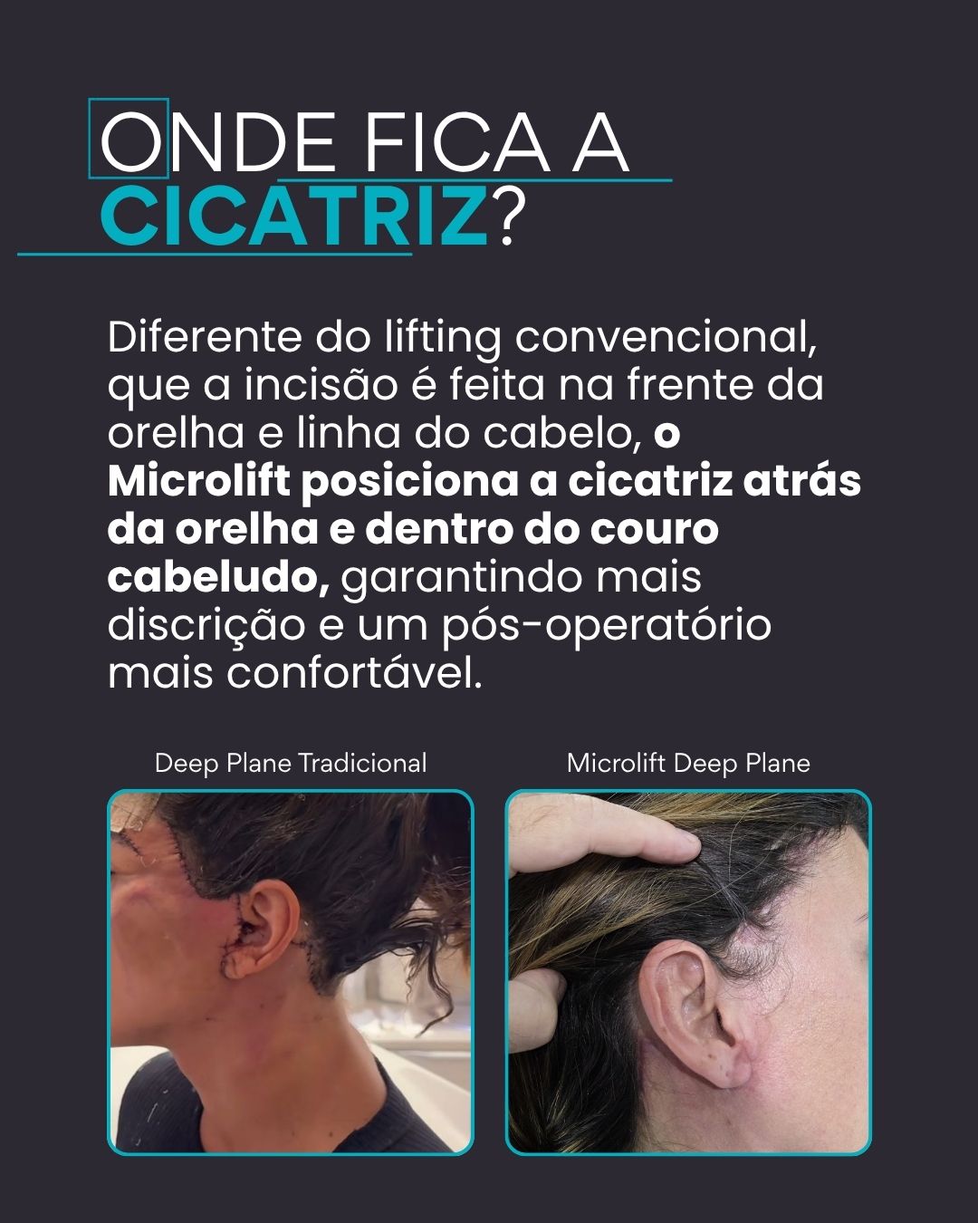 Onde fica a cicatriz? Ao contrário do lifting convencional, o Microlift posiciona a cicatriz atrás da orelha e dentro do couro cabeludo, garantindo mais discrição e um pós-operatório mais confortável.