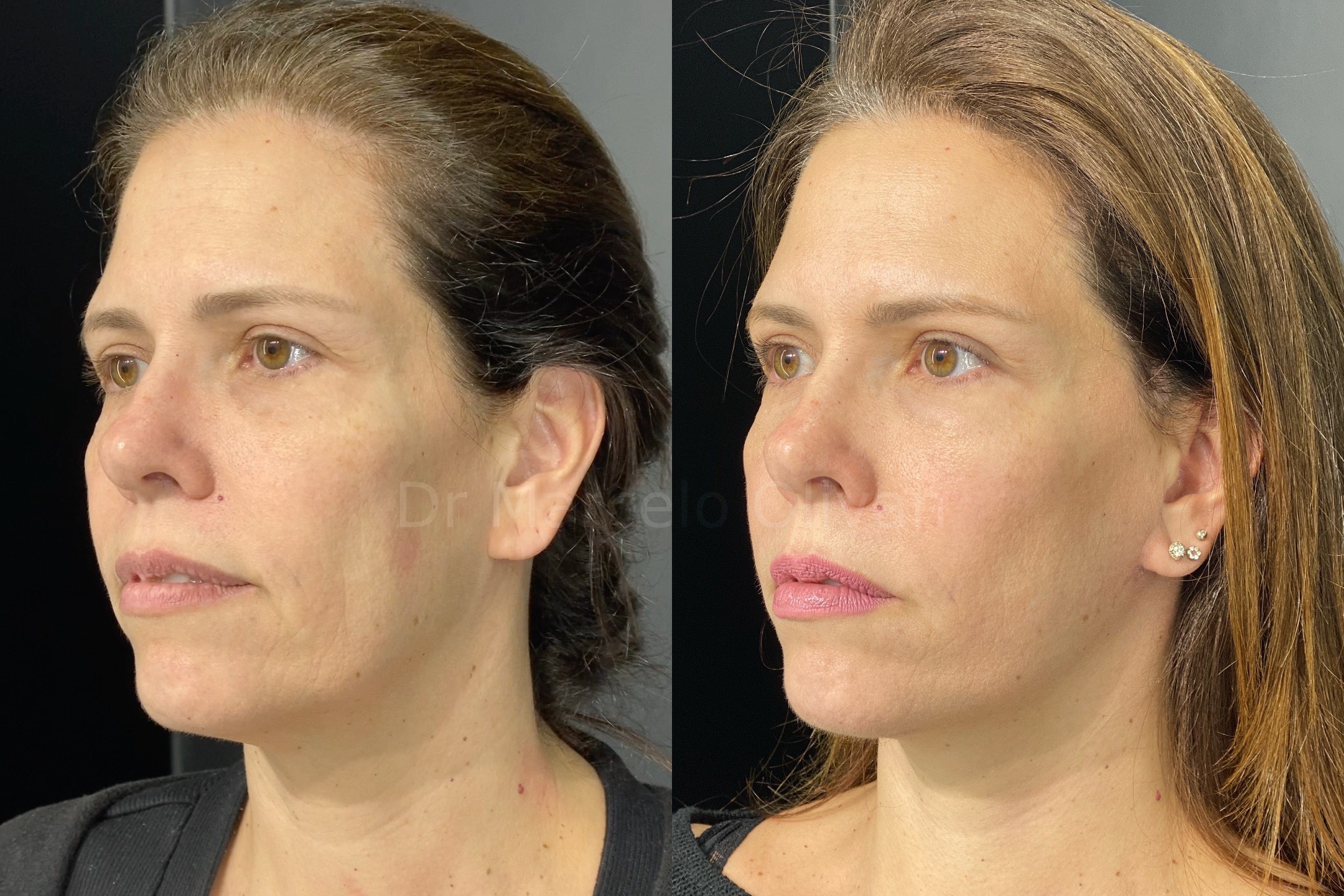 Antes e depois - visão angular