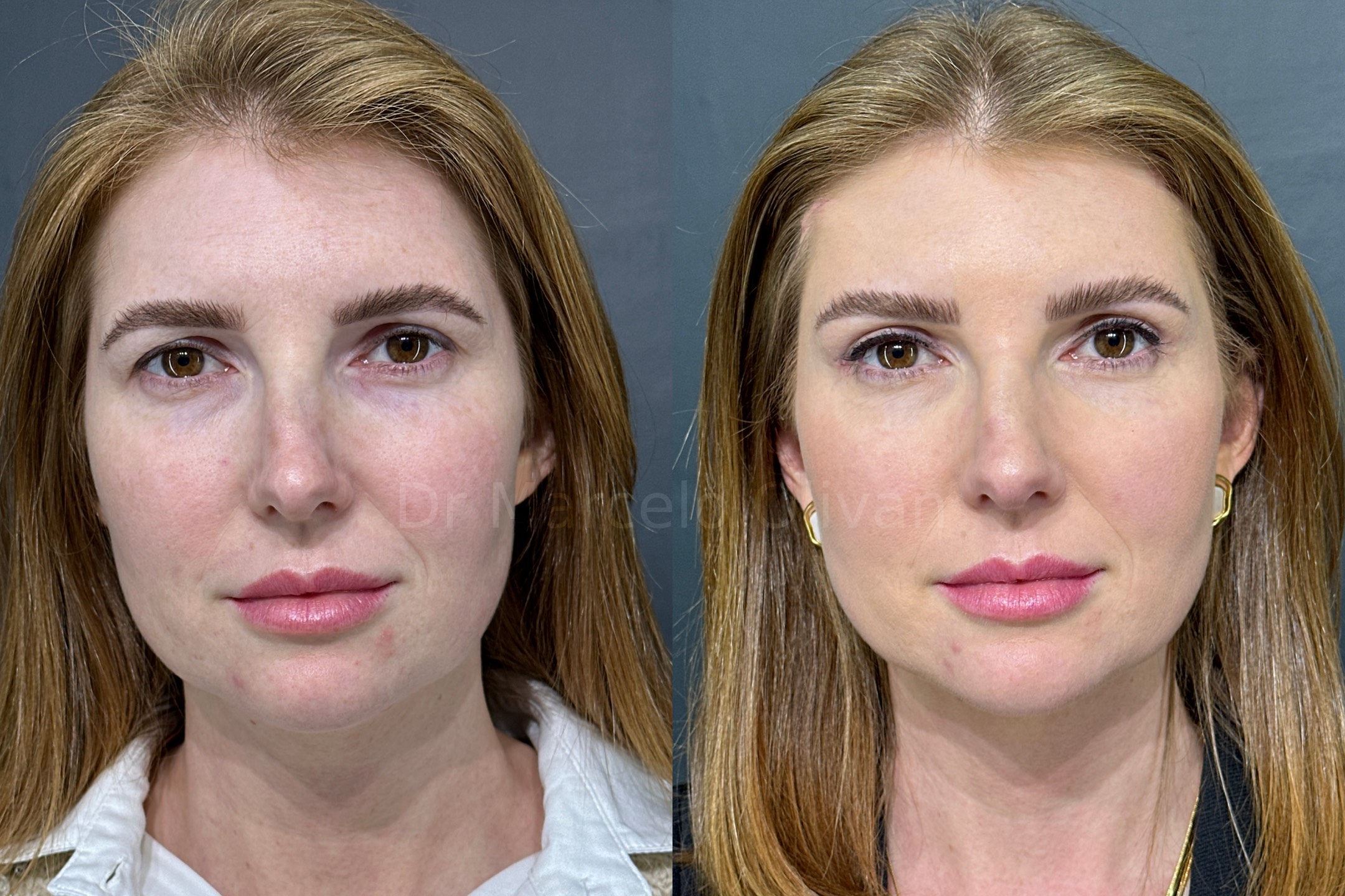 Antes e depois - visão frontal