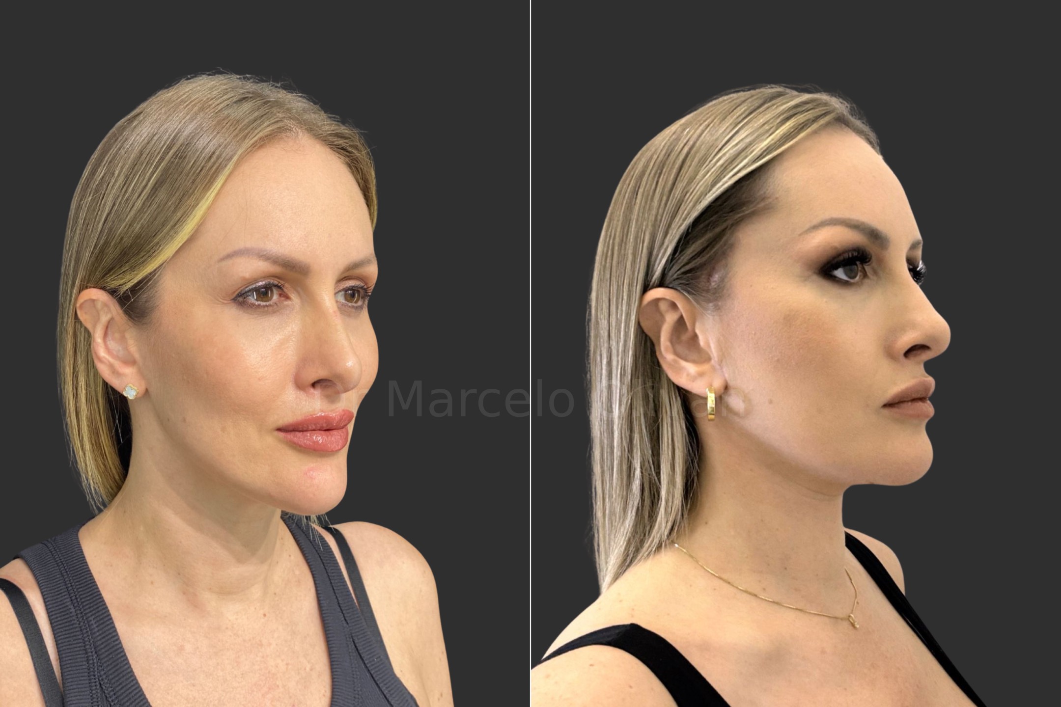 Antes e depois - visão angular