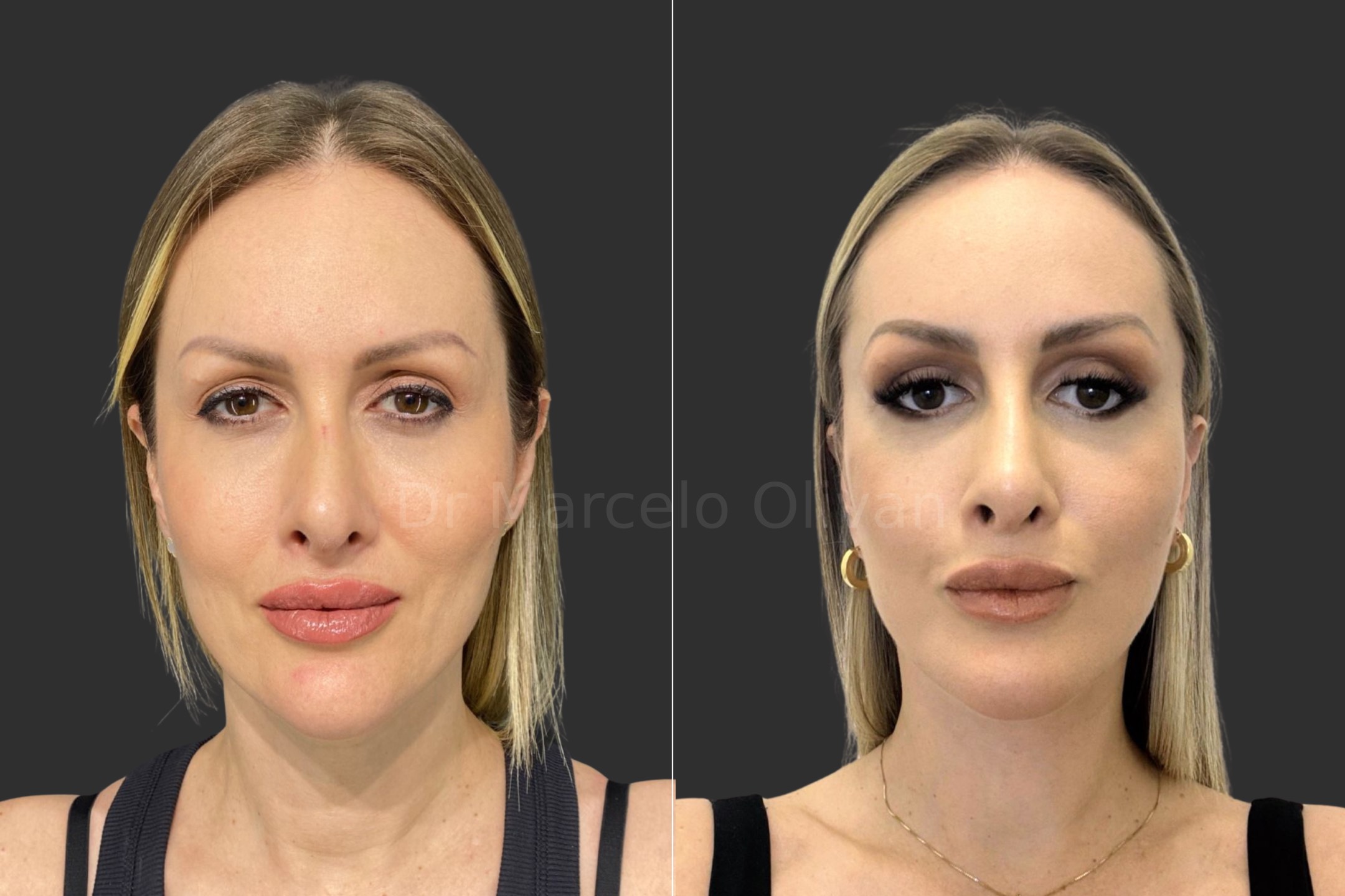 Antes e depois - visão frontal