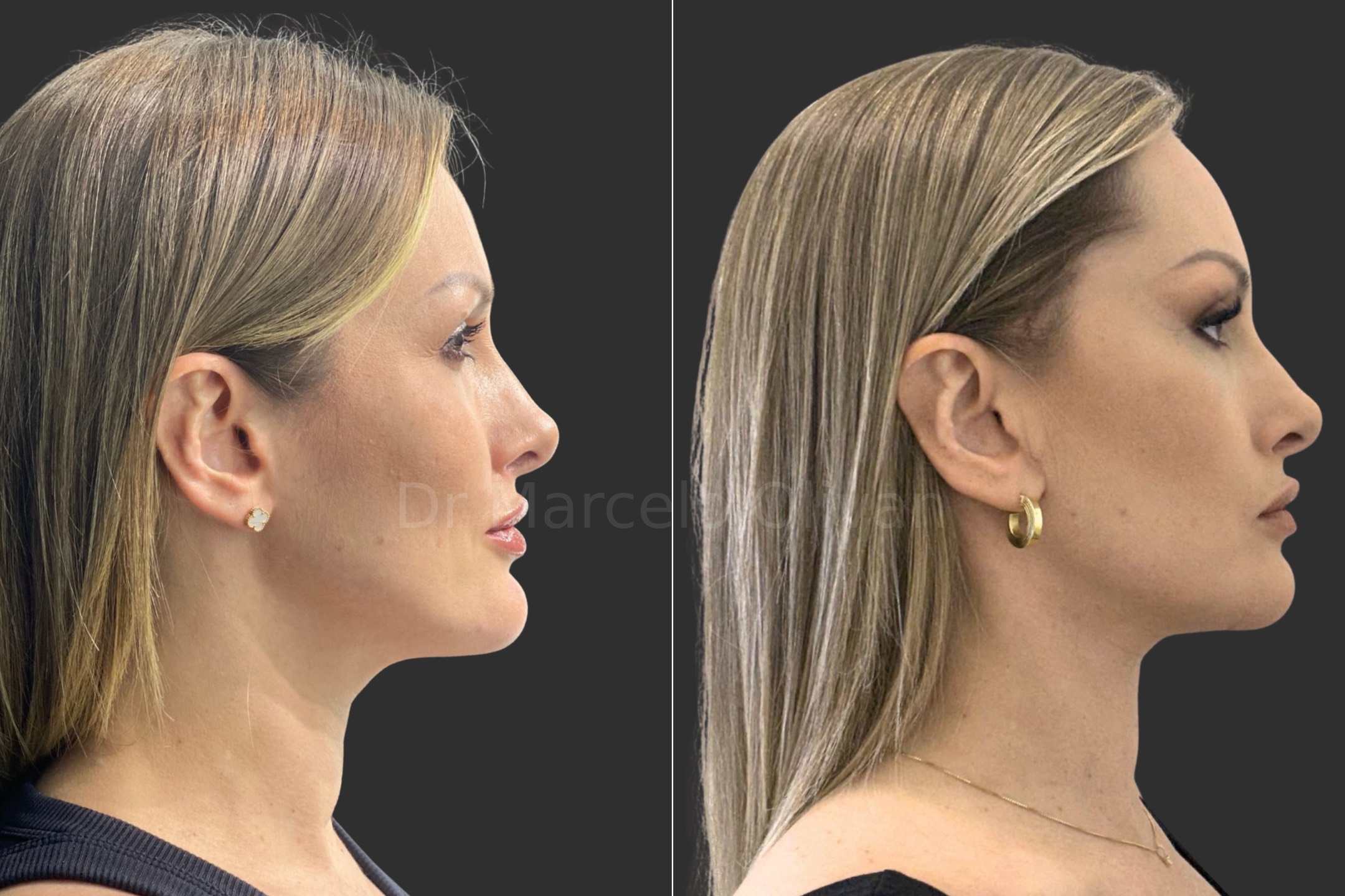 Antes e depois - visão lateral