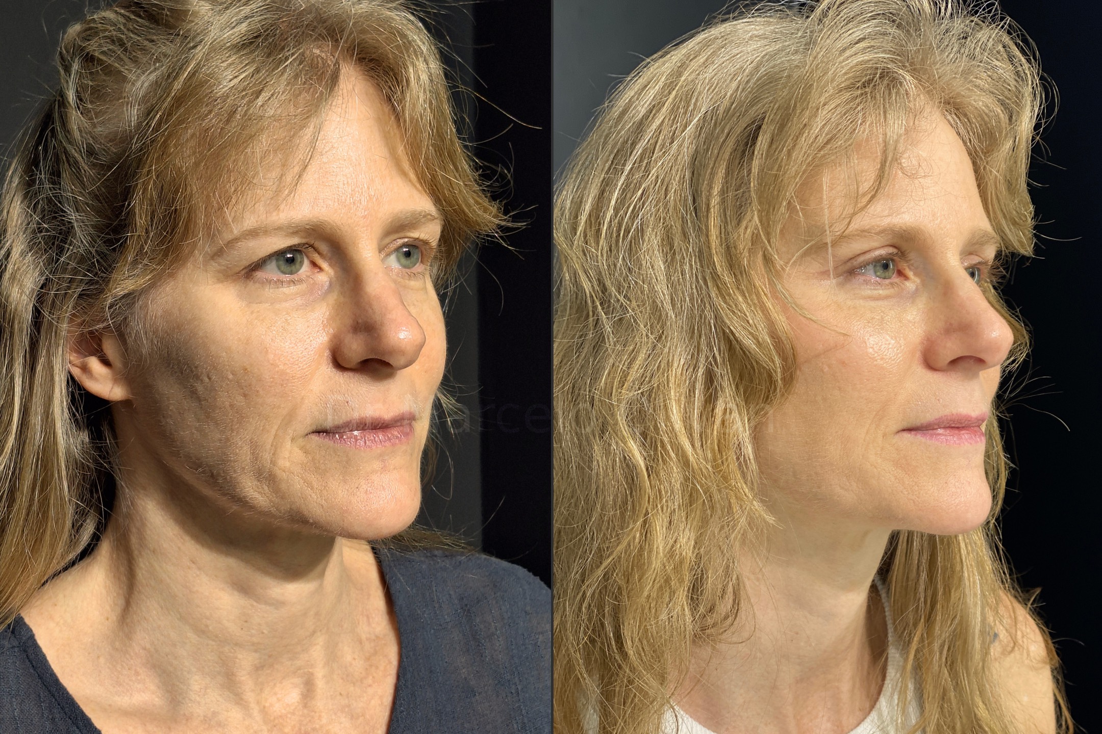 Antes e depois - visão angular