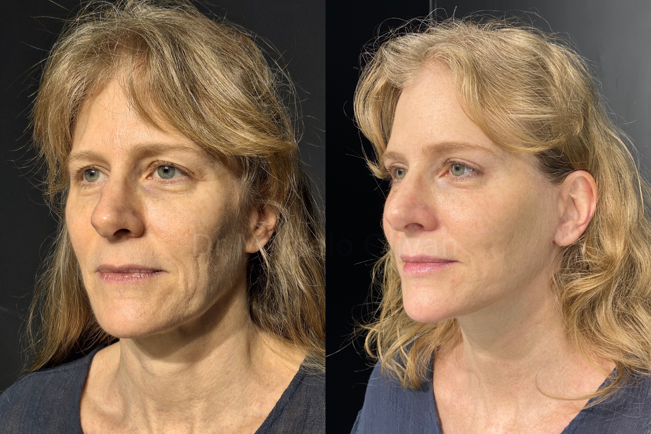 Antes e depois - visão angular