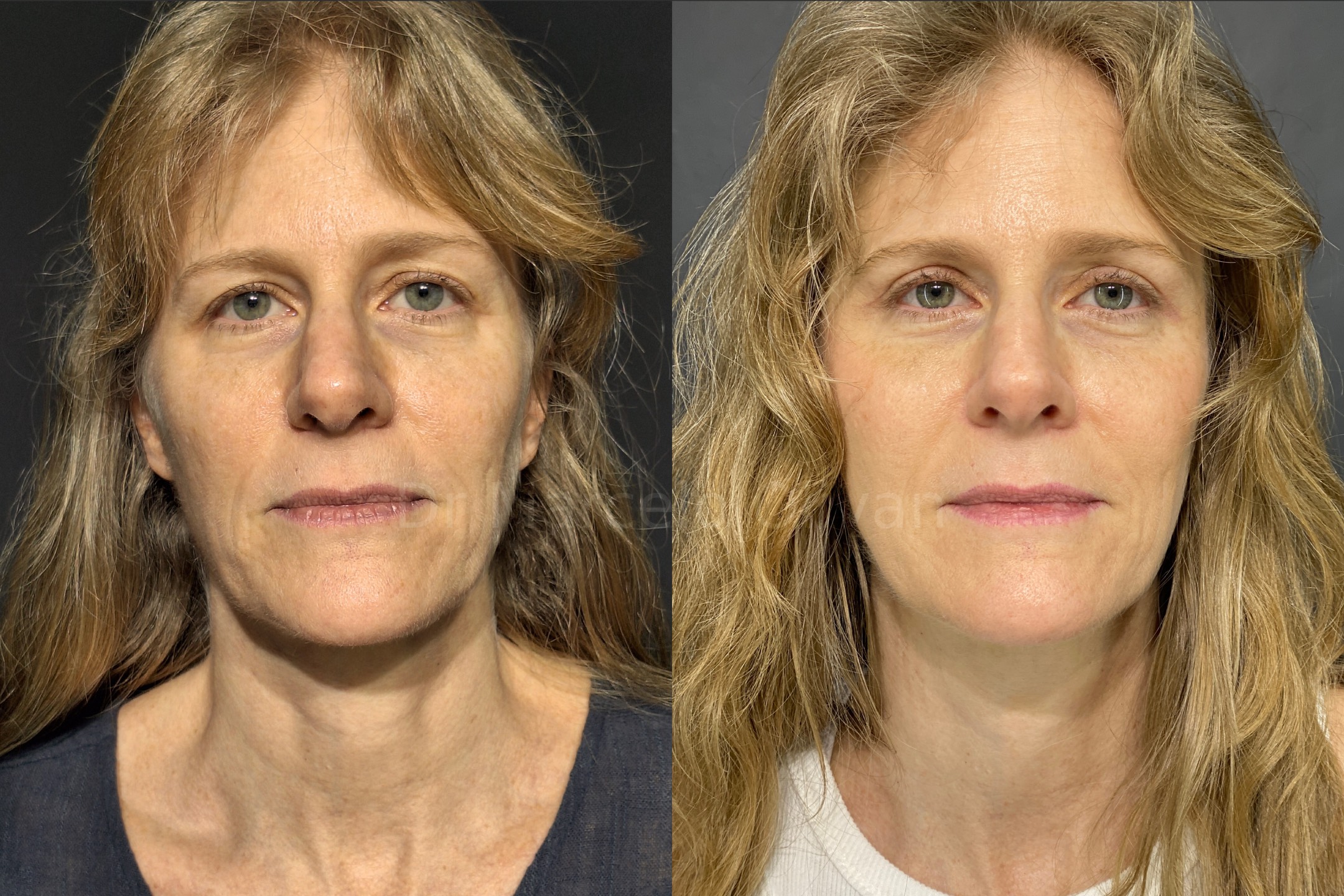 Antes e depois - visão frontal