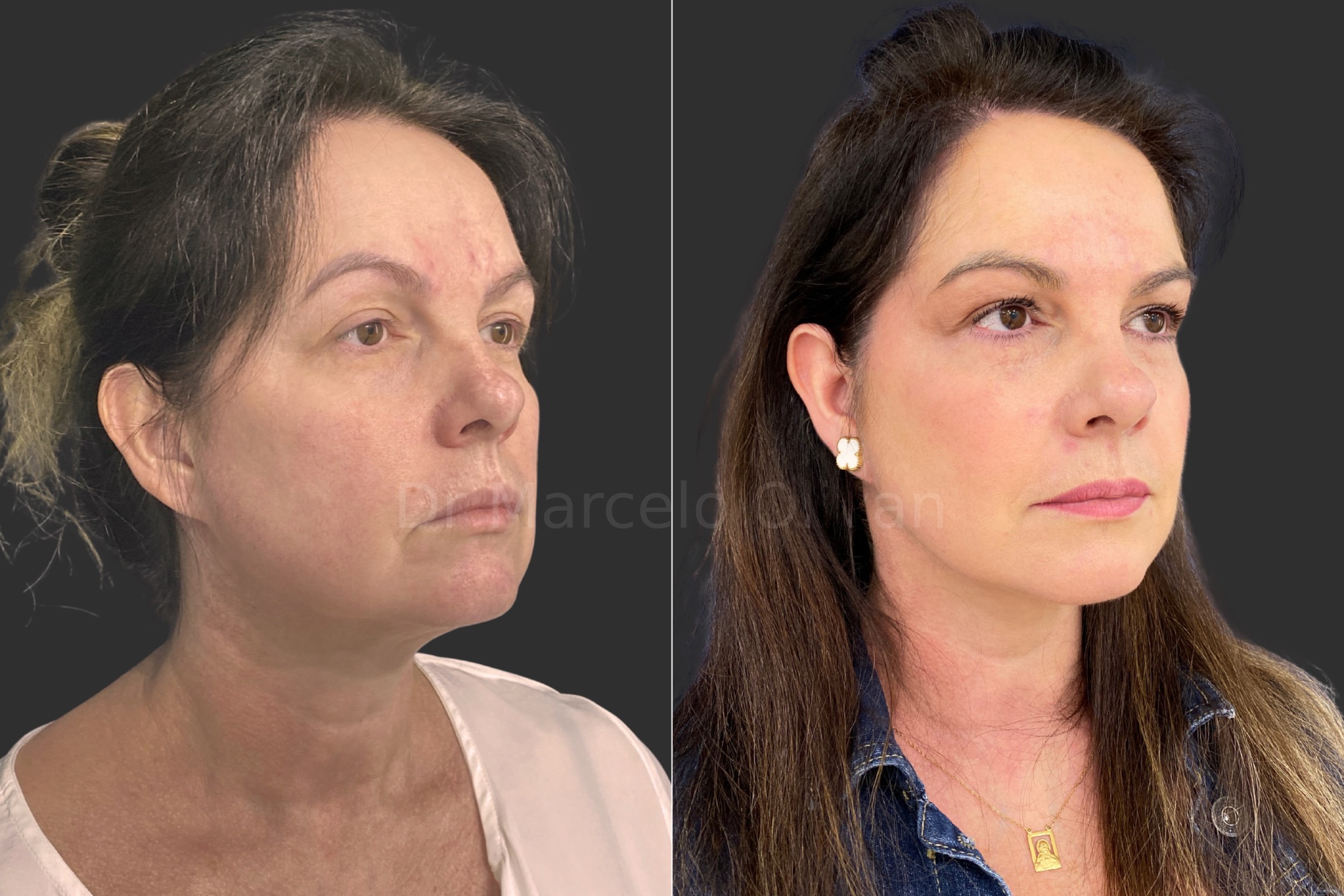 Antes e depois - visão angular